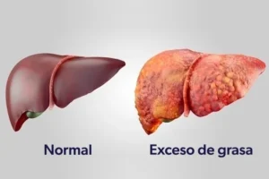 Higado graso