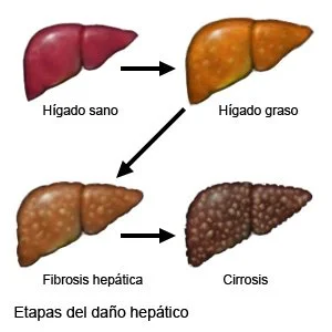 Higado graso e higado sano